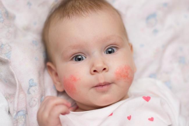 תינוק קטן סובל מפריחה בעור באזור הלחיים, סוג של אקזמה 